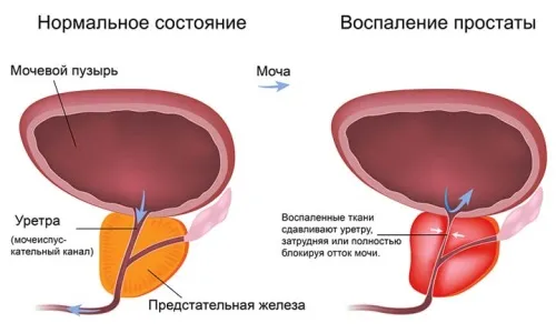 Eroprostin