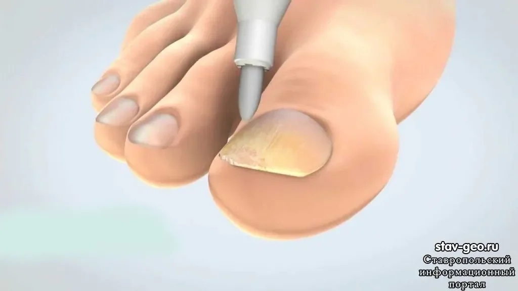Exofeet oil